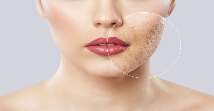 How to Get Rid of Acne Scars and Dark Marks